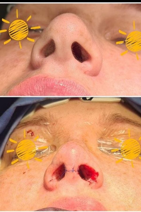 Nose Job Johannesburg