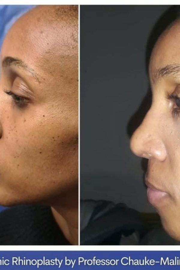 Rhinoplasty Johannesburg