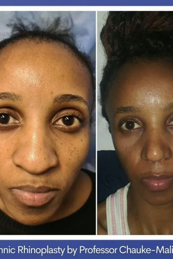 Rhinoplasty Surgeon Johannesburg